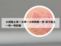 小孩腿上有一小块一小块和癣一样 孩子腿上一块一块的癣