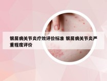 银屑病关节炎疗效评价标准 银屑病关节炎严重程度评价