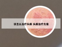 该怎么治疗头癣 头癣治疗方案