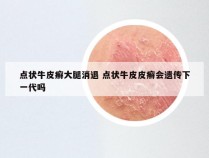 点状牛皮癣大腿消退 点状牛皮皮癣会遗传下一代吗