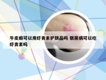 牛皮癣可以用虾青素护肤品吗 银屑病可以吃虾青素吗