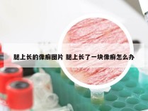 腿上长的像癣图片 腿上长了一块像癣怎么办