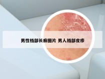 男性档部长癣图片 男人裆部皮疹