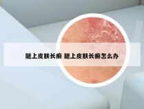 腿上皮肤长癣 腿上皮肤长癣怎么办