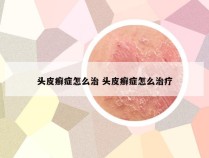 头皮癣症怎么治 头皮癣症怎么治疗