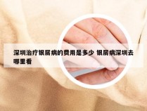 深圳治疗银屑病的费用是多少 银屑病深圳去哪里看