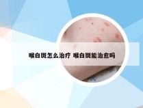 喉白斑怎么治疗 喉白斑能治愈吗