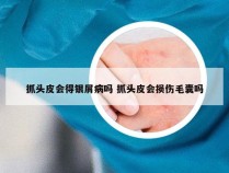 抓头皮会得银屑病吗 抓头皮会损伤毛囊吗