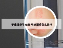 甲床湿疹牛皮癣 甲床湿疹怎么治疗