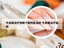 牛皮廨治疗到哪个医院能治好 牛皮廨治疗贴吧