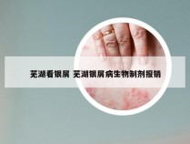 芜湖看银屑 芜湖银屑病生物制剂报销