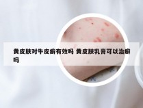 黄皮肤对牛皮癣有效吗 黄皮肤乳膏可以治癣吗