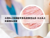 小孩头上有癣起可多头皮屑怎么办 小儿头上长癣像头皮屑