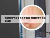 银屑病关节炎多久合并肠炎 银屑病关节炎彻底消失