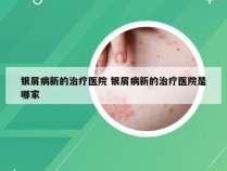 银屑病新的治疗医院 银屑病新的治疗医院是哪家