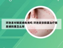 环孢素对银屑病有用吗 环孢素软胶囊治疗银屑病效果怎么样