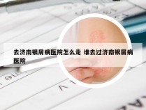 去济南银屑病医院怎么走 谁去过济南银屑病医院