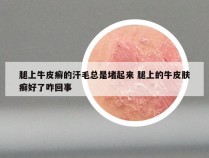 腿上牛皮癣的汗毛总是堵起来 腿上的牛皮肤癣好了咋回事