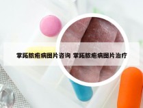 掌跖脓疱病图片咨询 掌跖脓疱病图片治疗