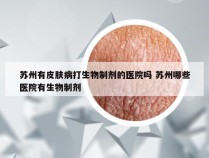 苏州有皮肤病打生物制剂的医院吗 苏州哪些医院有生物制剂