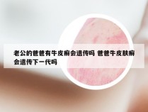 老公的爸爸有牛皮癣会遗传吗 爸爸牛皮肤癣会遗传下一代吗