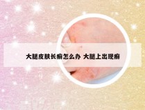 大腿皮肤长癣怎么办 大腿上出现癣