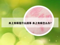 身上有癣是什么回事 身上有癣怎么办?