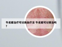 牛皮廨治疗可以换血疗法 牛皮廨可以根治吗?