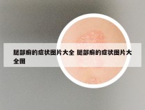 腿部癣的症状图片大全 腿部癣的症状图片大全图