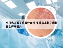 小孩头上长了癣长什么样 小孩头上长了癣长什么样子图片