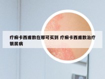 疗癣卡西甫散在那可买到 疗癣卡西甫散治疗银屑病