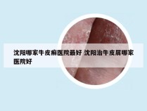 沈阳哪家牛皮癣医院最好 沈阳治牛皮屑哪家医院好