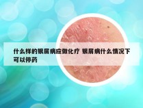 什么样的银屑病应做化疗 银屑病什么情况下可以停药