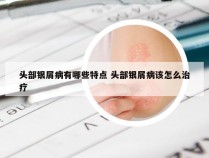 头部银屑病有哪些特点 头部银屑病该怎么治疗