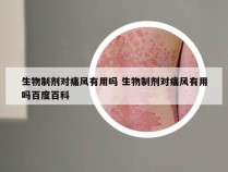 生物制剂对痛风有用吗 生物制剂对痛风有用吗百度百科