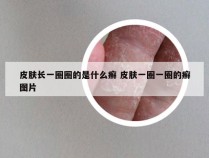 皮肤长一圈圈的是什么癣 皮肤一圈一圈的癣图片