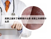 皮肤上面长了癣要用什么擦 皮肤上长癣擦什么药