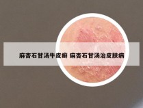 麻杏石甘汤牛皮癣 麻杏石甘汤治皮肤病