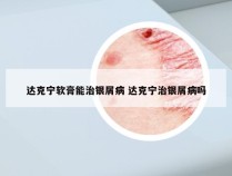 达克宁软膏能治银屑病 达克宁治银屑病吗