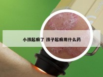 小孩起癣了 孩子起癣用什么药