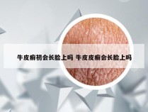 牛皮癣初会长脸上吗 牛皮皮癣会长脸上吗