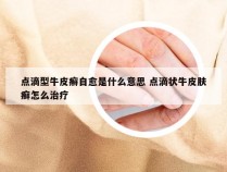 点滴型牛皮癣自愈是什么意思 点滴状牛皮肤癣怎么治疗