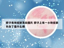 脖子有块皮肤发白图片 脖子上有一小块皮肤长白了是什么病