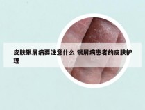 皮肤银屑病要注意什么 银屑病患者的皮肤护理