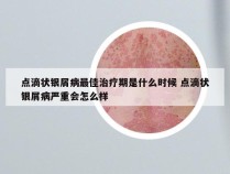 点滴状银屑病最佳治疗期是什么时候 点滴状银屑病严重会怎么样