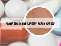 足癣真菌感染用什么药最好 角质化足癣图片