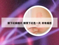 腋下红癣图片 腋窝下红色一片 并有痛感