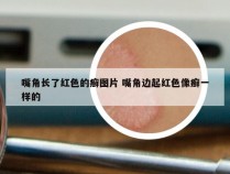 嘴角长了红色的癣图片 嘴角边起红色像癣一样的