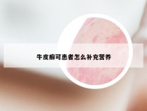 牛皮癣可患者怎么补充营养