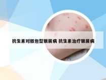 抗生素对脓包型银屑病 抗生素治疗银屑病